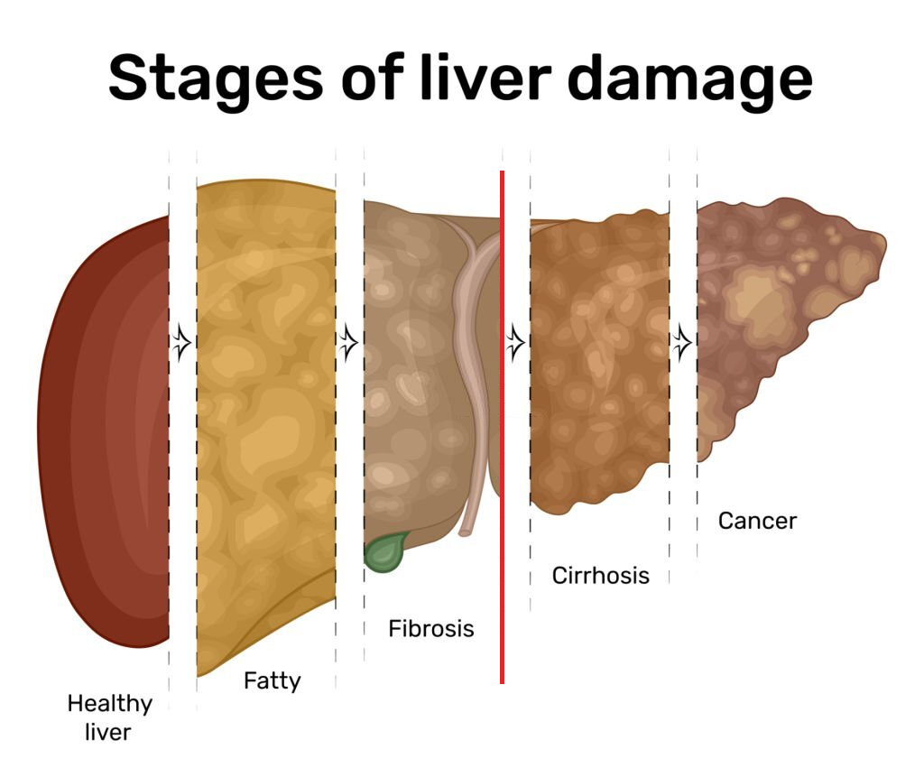 Stages of liver damage: healthy, fatty, fibrosis, cirrhosis